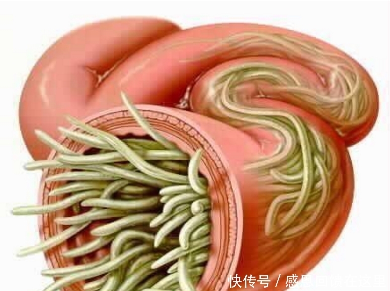  虫子|男子被吃脑虫入侵20天后病逝, 提醒: 这几种常见寄生虫得小心