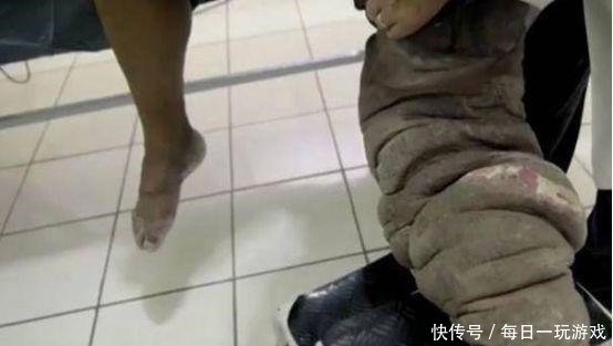  男子|男子只因20年前被蚊子叮了一下, 却要承受无尽的痛苦, 引人忧心