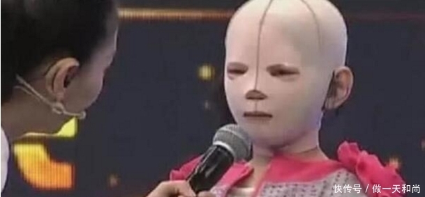  生活|小姑娘因一场车祸毁容，此后戴头套生活4年，当卸下头套后全场鸦雀无声