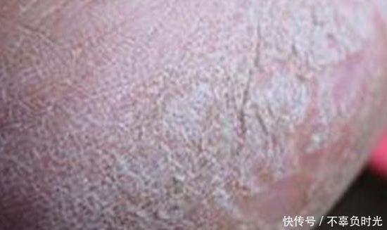 干裂|脚后跟干裂，跟身体健康有关系吗？不要再忽视了