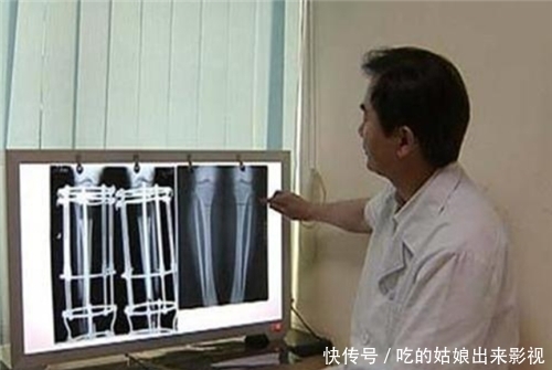 李亚诺|6年前,那个花16万,断骨增高7.2厘米高三男生,如今却后悔了