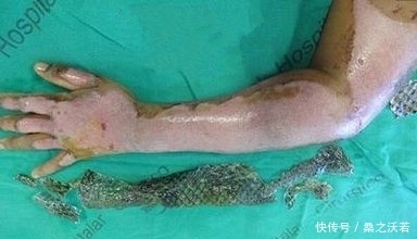 手臂|农村男子手臂意外烧伤,媳妇用鱼皮包裹,结果却让人惊喜