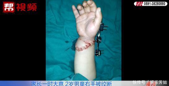 医生|家长来医院竟带着一只两岁男童的右手？在场所有人都惊呆了！