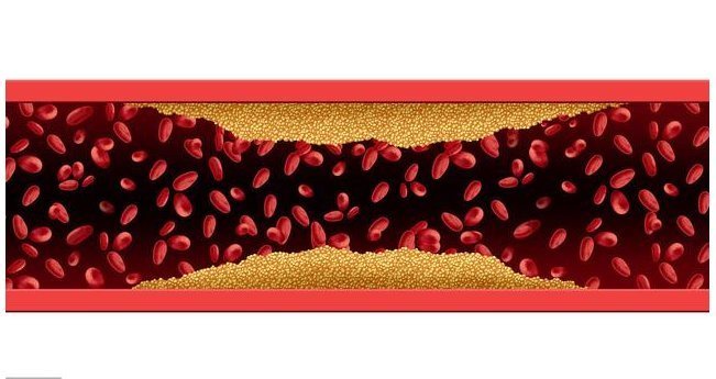 复发|脑梗不到1年就复发，如何预防？坚持做好3件事，养血管保健康