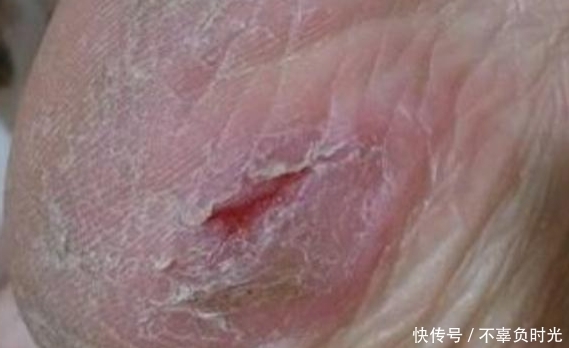 干裂|脚后跟干裂，跟身体健康有关系吗？不要再忽视了