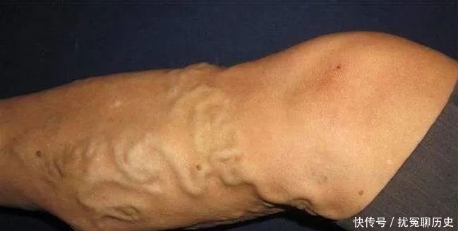 静脉曲张加重到出现下肢溃疡,必须马上治疗